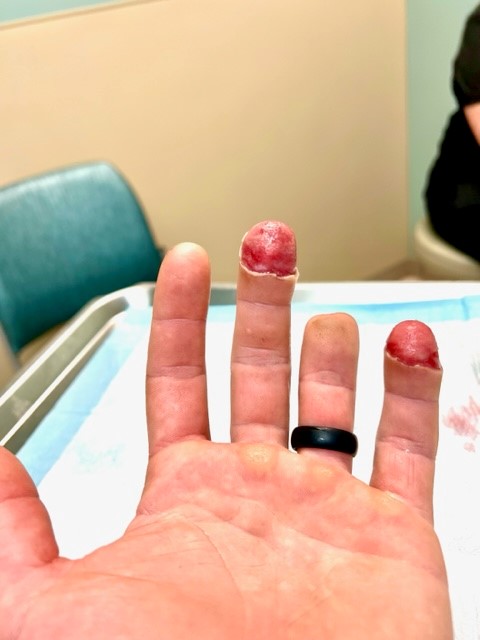 Bloodied fingertips after frostbite.